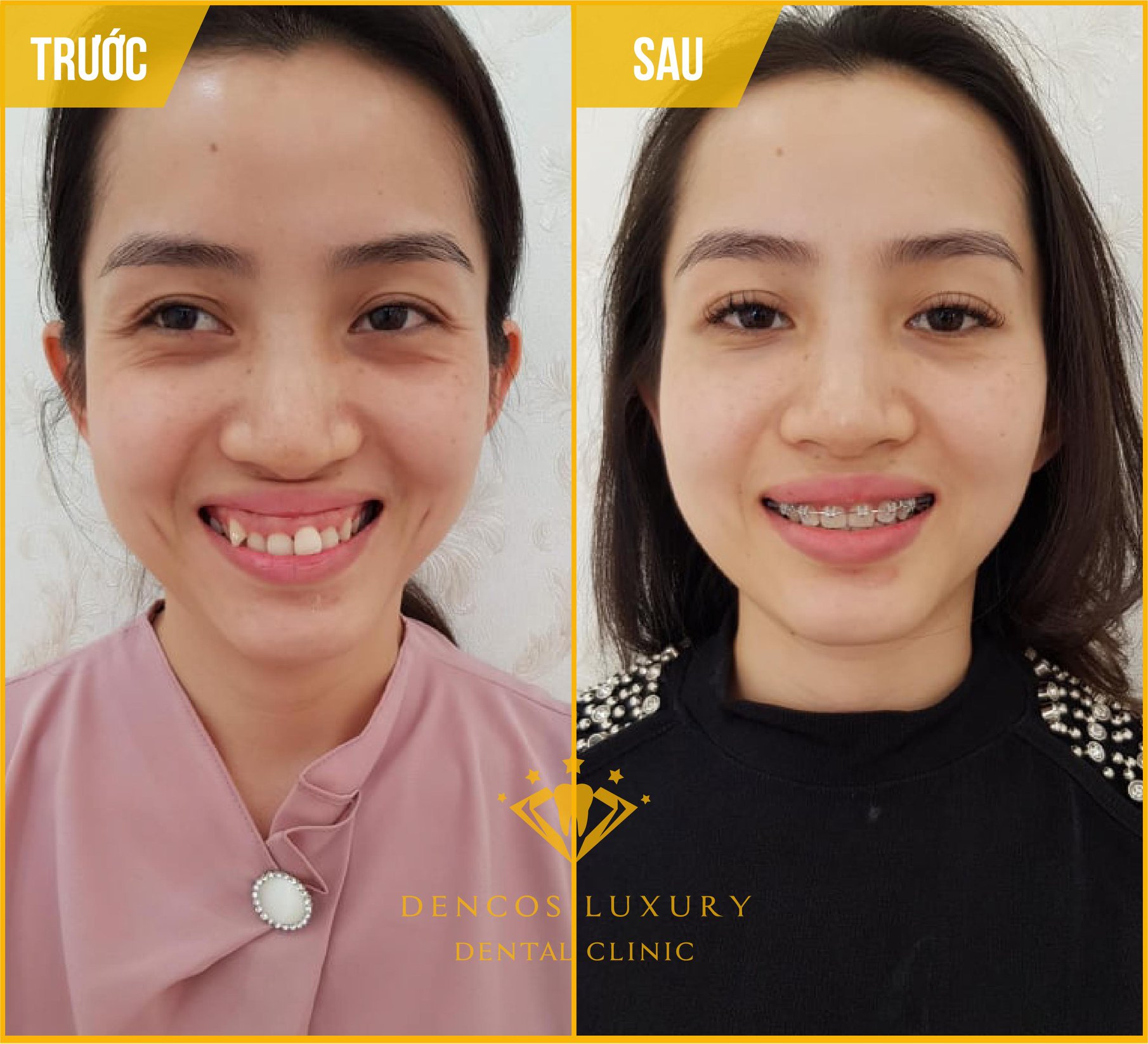 hình ảnh niềng răng mắc cài kim loại