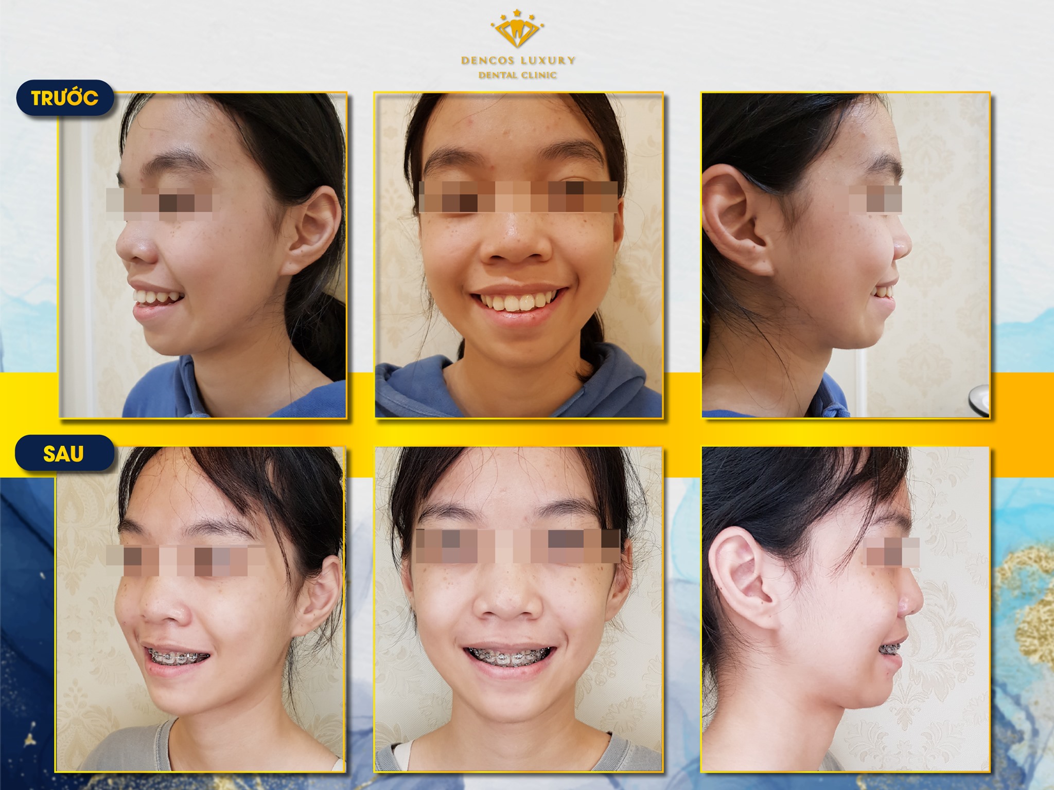 hình ảnh niềng răng mắc cài kim loại