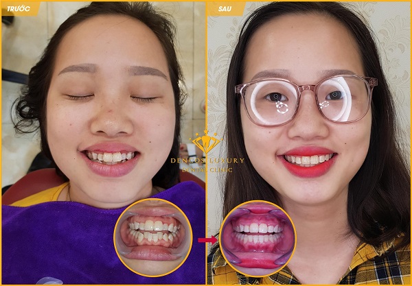 hình ảnh niềng răng mắc cài kim loại