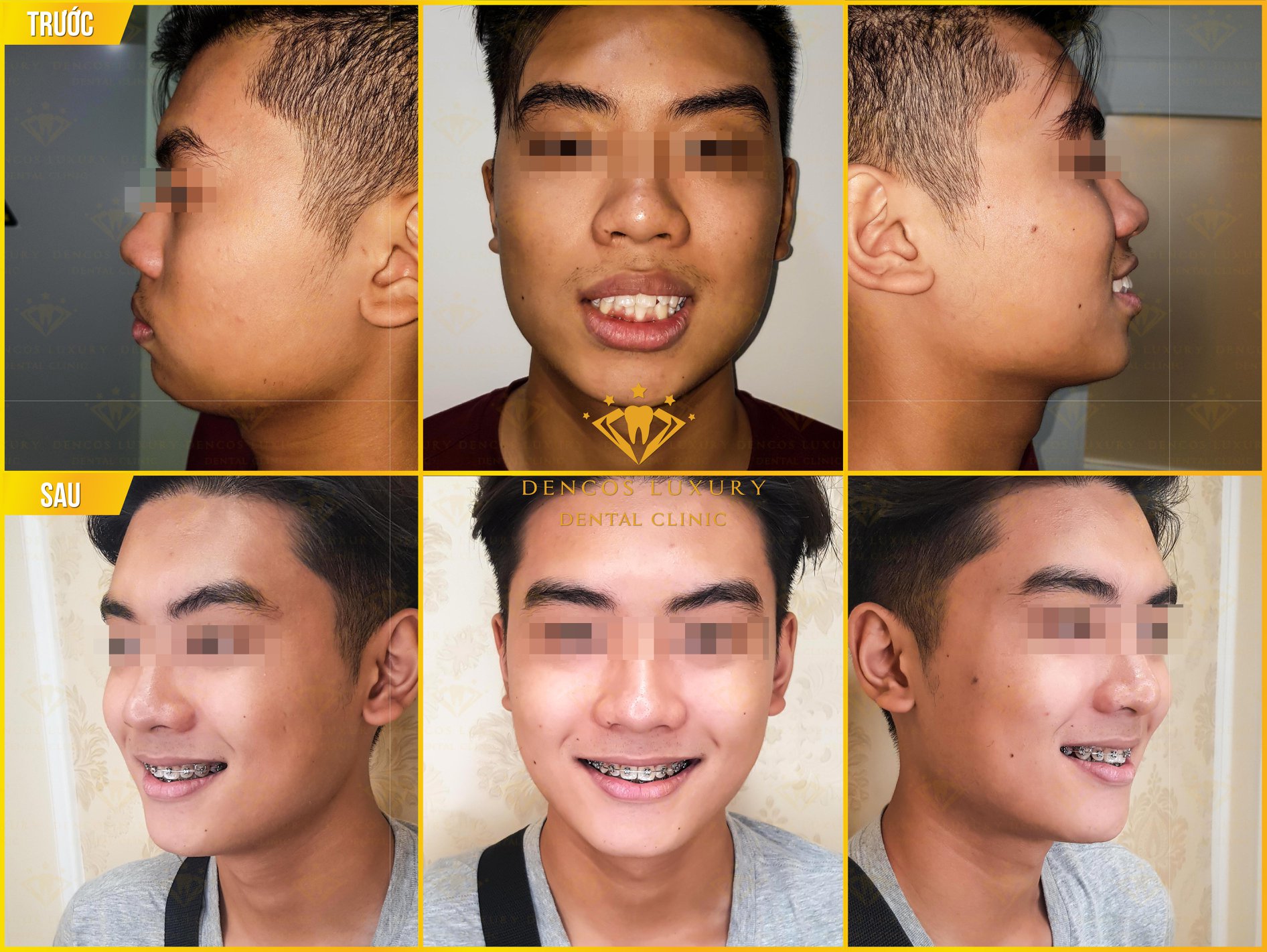 hình ảnh niềng răng mắc cài kim loại