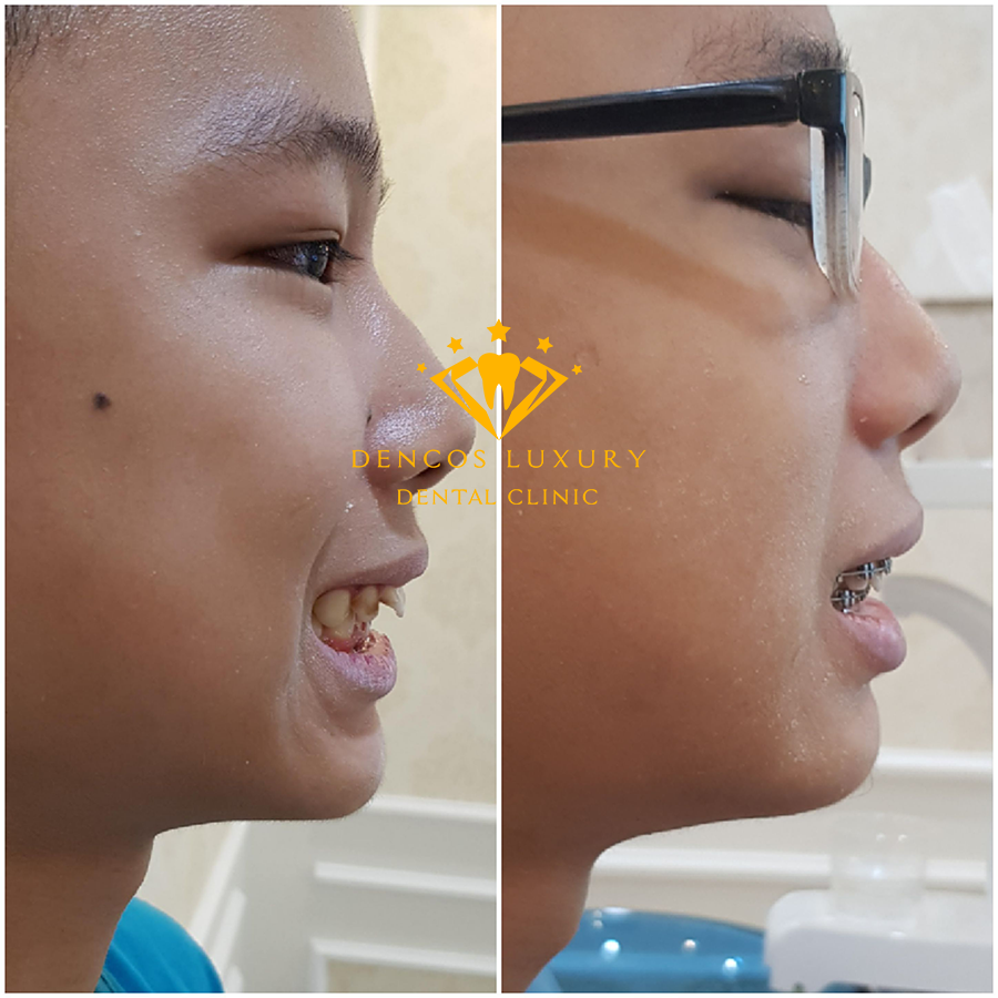 hình ảnh niềng răng mắc cài kim loại