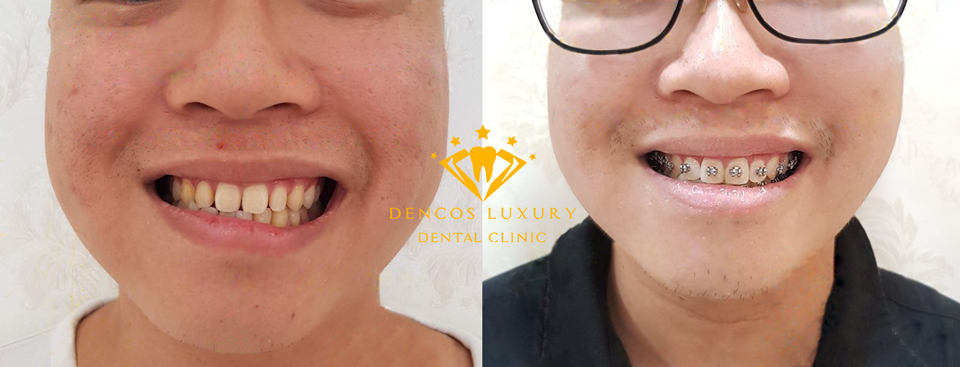 hình ảnh niềng răng mắc cài kim loại