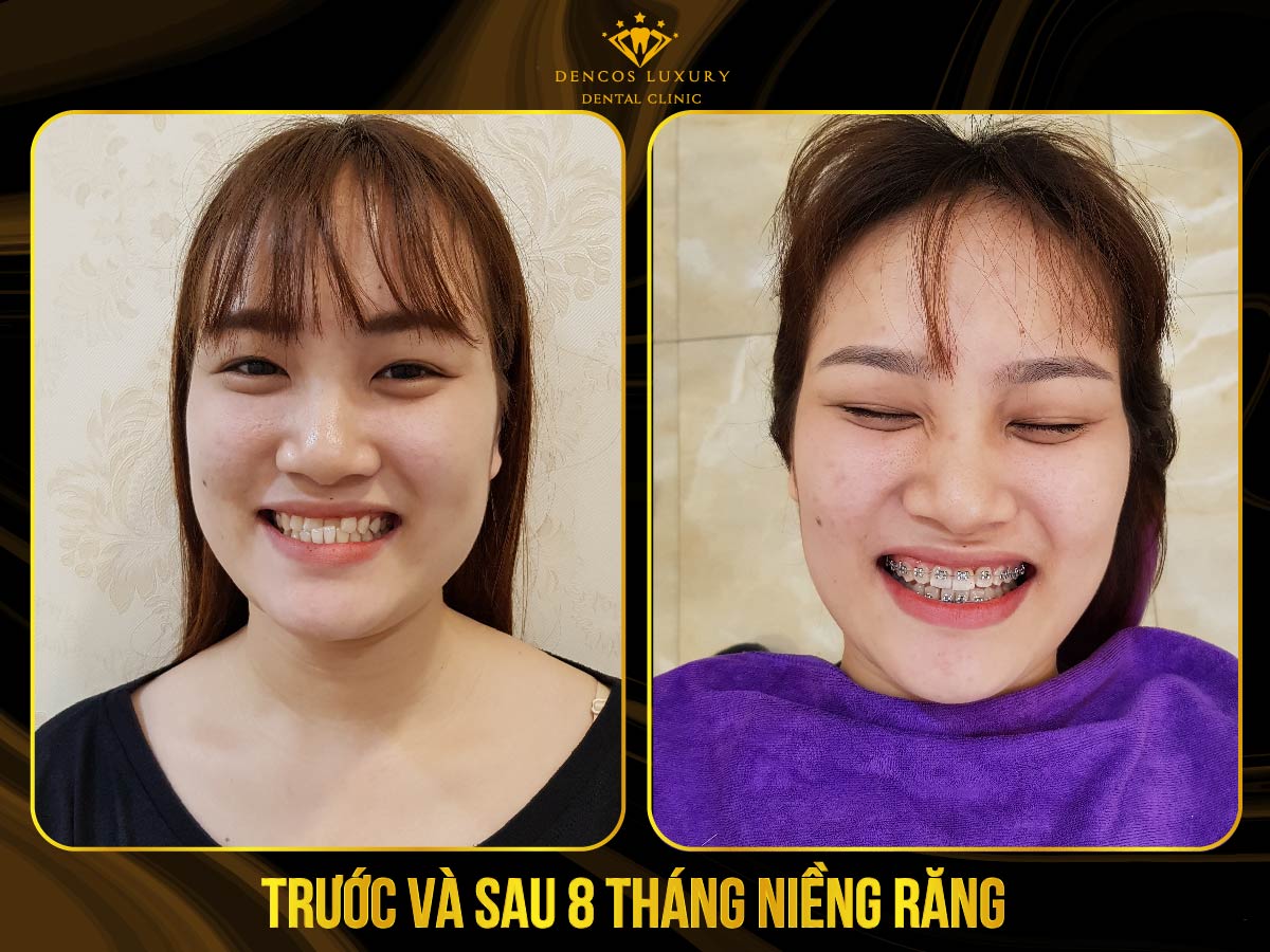 hình ảnh niềng răng mắc cài kim loại