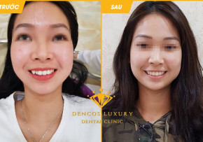 NIỀNG RĂNG CÓ GIÚP BẠN XINH ĐẸP HƠN KHÔNG? XEM NGAY KẺO LỠ