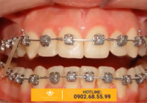 KẾT QUẢ NIỀNG RĂNG KHẤP KHỂNH