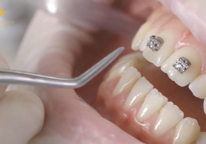 QUY TRÌNH GẮN NIỀNG RĂNG MẮC CÀI KIM LOẠI THÔNG MINH NHƯ THẾ NÀO?