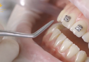 QUY TRÌNH GẮN NIỀNG RĂNG MẮC CÀI KIM LOẠI THÔNG MINH NHƯ THẾ NÀO?