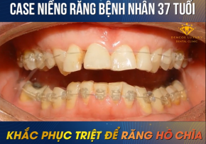 LỚN TUỔI CÓ NIỀNG RĂNG ĐƯỢC KHÔNG – [GÓC TƯ VẤN]