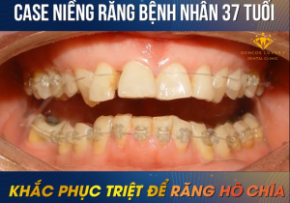 LỚN TUỔI CÓ NIỀNG RĂNG ĐƯỢC KHÔNG – [GÓC TƯ VẤN]
