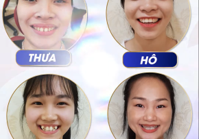 Review niềng răng thẩm mỹ: An toàn – Chất lượng – Bảo tồn răng thật