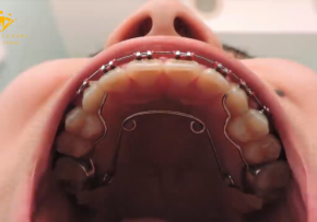 KẾT QUẢ KHÁCH HÀNG NIỀNG RĂNG TẠI DENCOS LUXURY (CÓ SỬ DỤNG NONG HÀM)