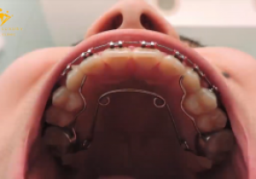 KẾT QUẢ KHÁCH HÀNG NIỀNG RĂNG TẠI DENCOS LUXURY (CÓ SỬ DỤNG NONG HÀM)