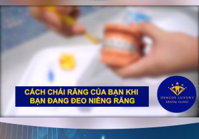 HƯỚNG DẪN CHẢI RĂNG ĐÚNG CÁCH KHI NIỀNG RĂNG