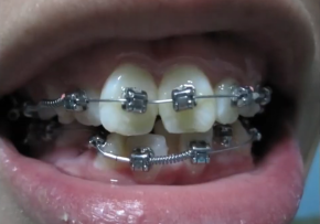 KẾT QUẢ SAU NIỀNG RĂNG KHẤP KHỂNH – RĂNG HÔ| NHA KHOA QUỐC TẾ DENCOS LUXURY