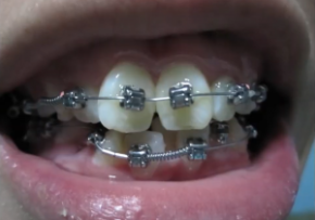 KẾT QUẢ SAU NIỀNG RĂNG KHẤP KHỂNH – RĂNG HÔ| NHA KHOA QUỐC TẾ DENCOS LUXURY