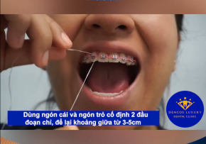 Cách sử dụng chỉ nha khoa cho người đang niềng răng
