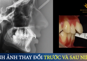 NIỀNG RĂNG HÔ VẨU CÓ CHỮA ĐƯỢC TRIỆT ĐỂ KHÔNG?