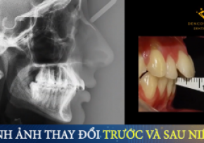 NIỀNG RĂNG HÔ VẨU CÓ CHỮA ĐƯỢC TRIỆT ĐỂ KHÔNG?