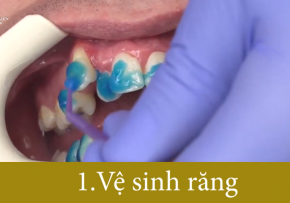 NIỀNG RĂNG TẠI NHA KHOA QUỐC TẾ DENCOS LUXURY THỰC HIỆN NHƯ THẾ NÀO?