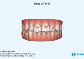 KẾT QUẢ CHỈNH NHA BẰNG NIỀNG RĂNG TRONG SUỐT INVISALIGN