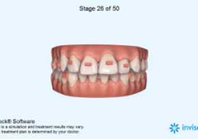 KẾT QUẢ CHỈNH NHA BẰNG NIỀNG RĂNG TRONG SUỐT INVISALIGN
