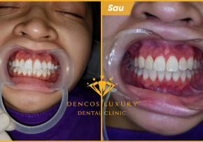 CẢM XÚC VỠ ÒA NGAY SAU KHI THÁO MẮC CÀI NIỀNG RĂNG