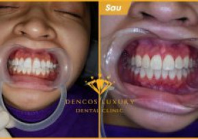 CẢM XÚC VỠ ÒA NGAY SAU KHI THÁO MẮC CÀI NIỀNG RĂNG