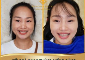 QUY TRÌNH GẮN NIỀNG RĂNG MẮC CÀI PHA LÊ CHO KHÁCH HÀNG