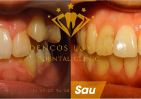 HÀNH TRÌNH NIỀNG RĂNG THAY ĐỔI NHƯ THẾ NÀO?