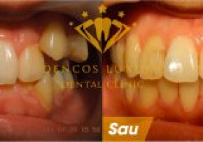 HÀNH TRÌNH NIỀNG RĂNG THAY ĐỔI NHƯ THẾ NÀO?