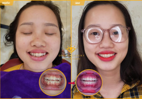 KHÁCH HÀNG: LÃ THỊ THÚY – NIỀNG RĂNG MẮC CÀI KIM LOẠI