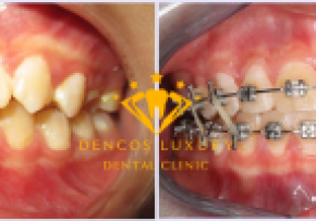 THÁO NIỀNG RĂNG CHO NỮ KỸ SƯ CÔNG NGHỆ CAO CỦA TẬP ĐOÀN VIETTEL TẠI DENCOS LUXURY