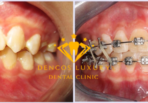 THÁO NIỀNG RĂNG CHO NỮ KỸ SƯ CÔNG NGHỆ CAO CỦA TẬP ĐOÀN VIETTEL TẠI DENCOS LUXURY