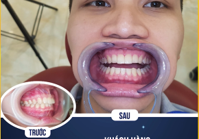 TRỞ THÀNH HOTBOY SAU KHI NIỀNG RĂNG THẨM MỸ TẠI DENCOS LUXURY