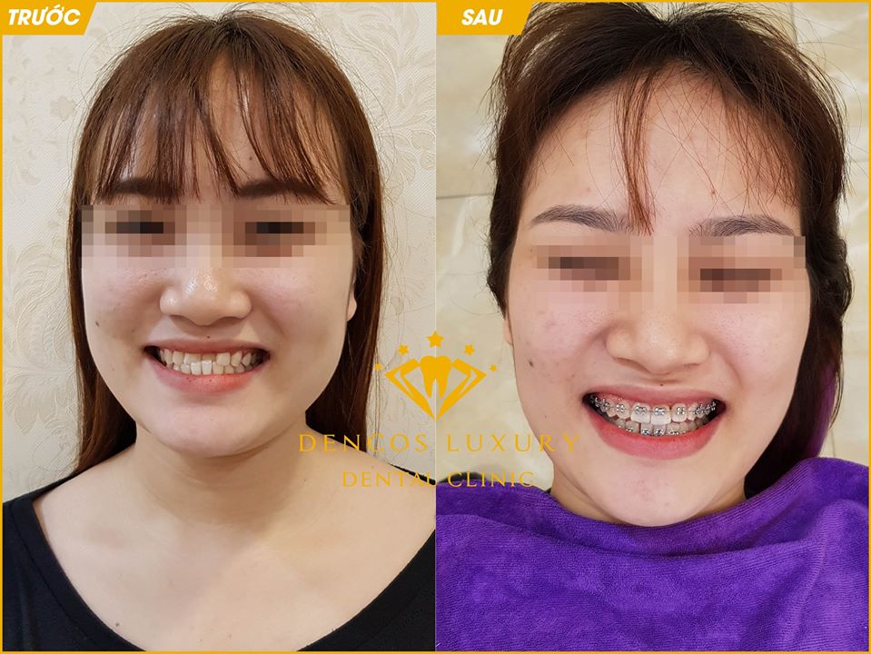 niềng răng mắc cài công nghệ 3D Speed