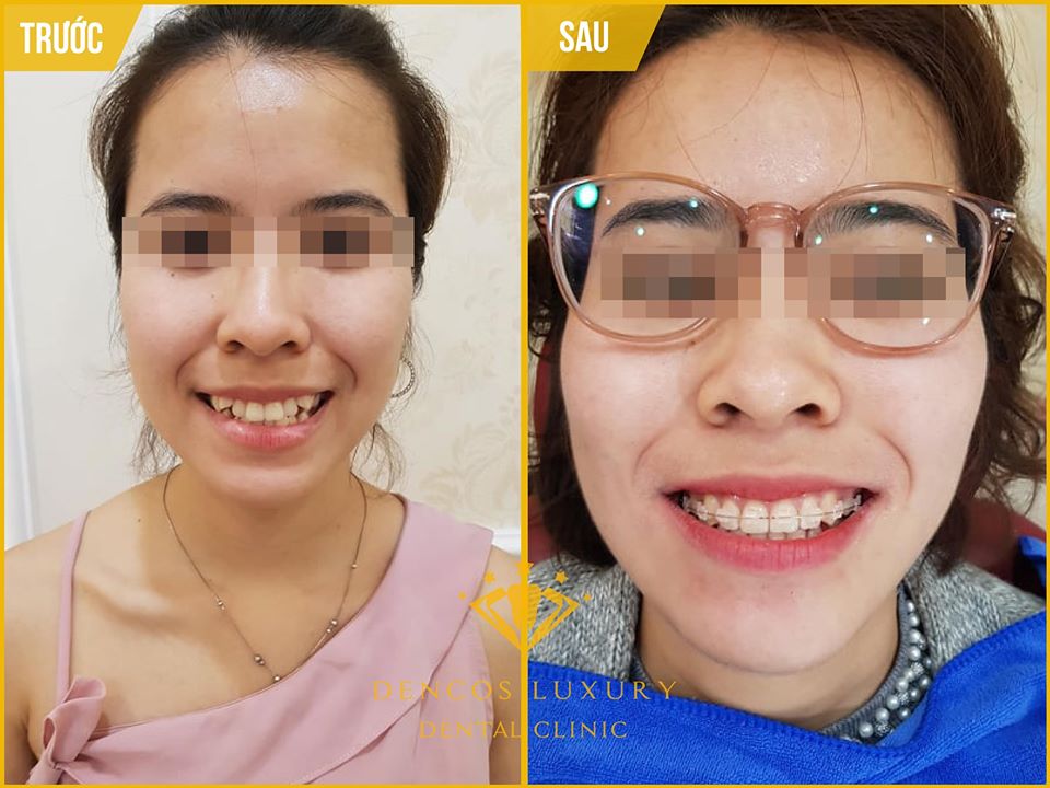 niềng răng mắc cài công nghệ 3D Speed