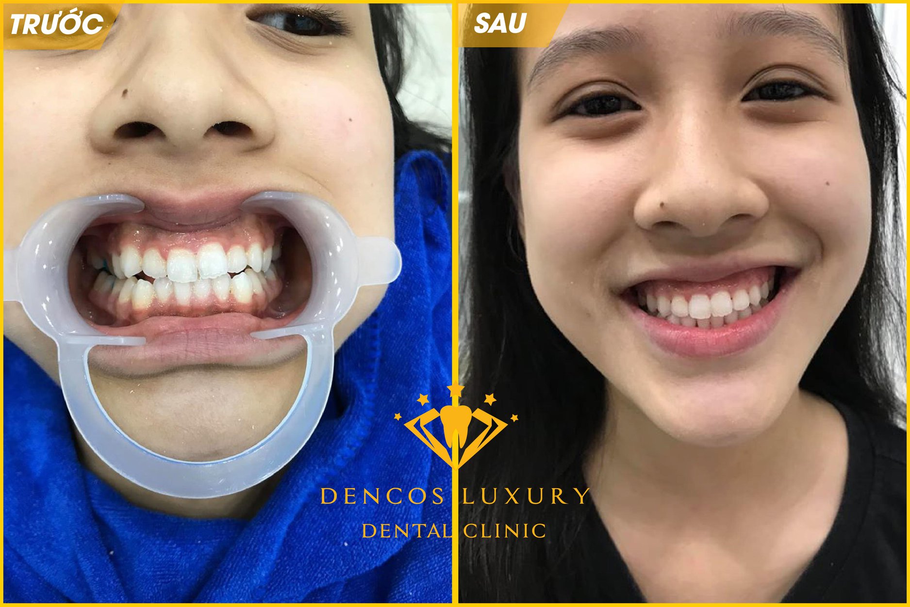 Niềng răng invisalign