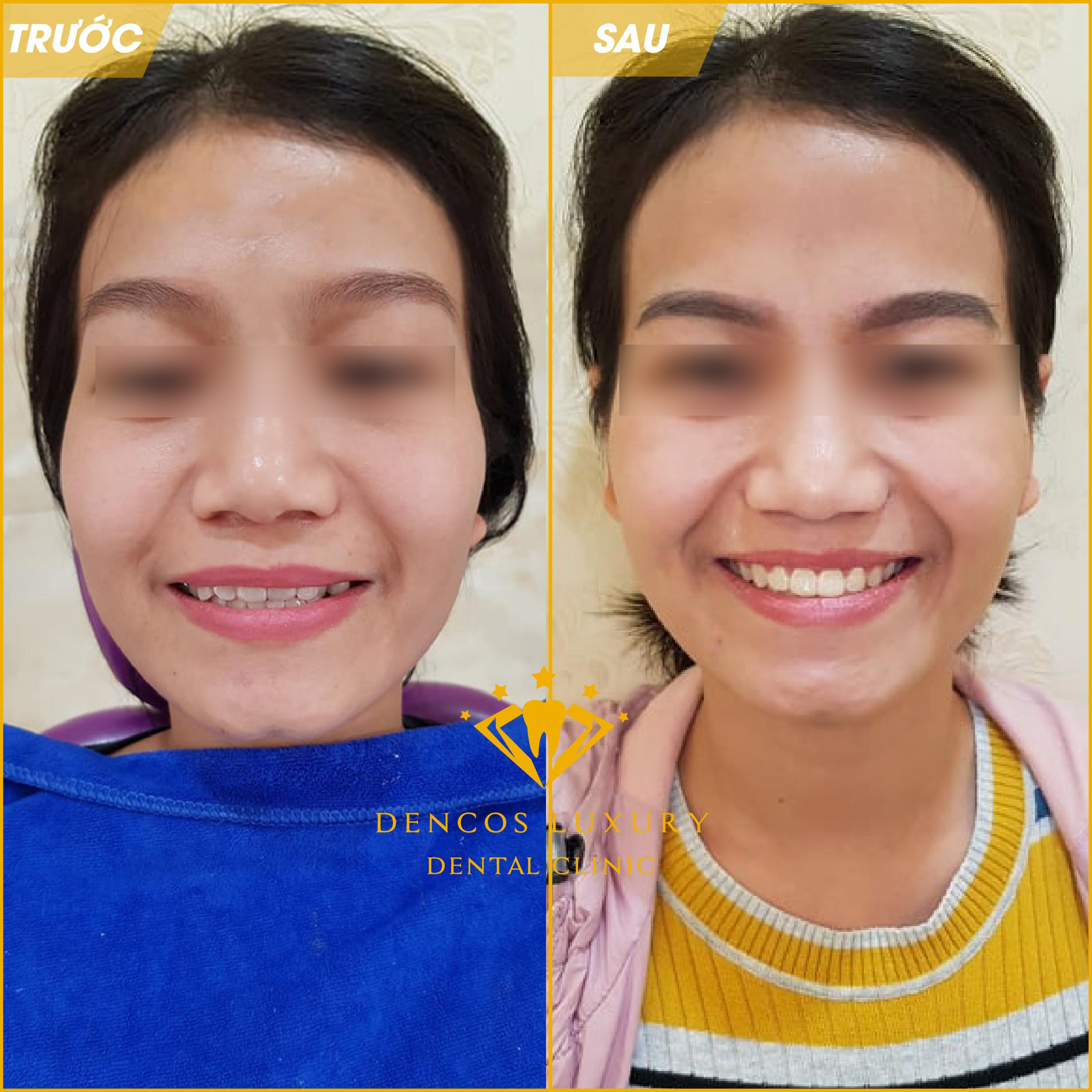 Niềng răng invisalign