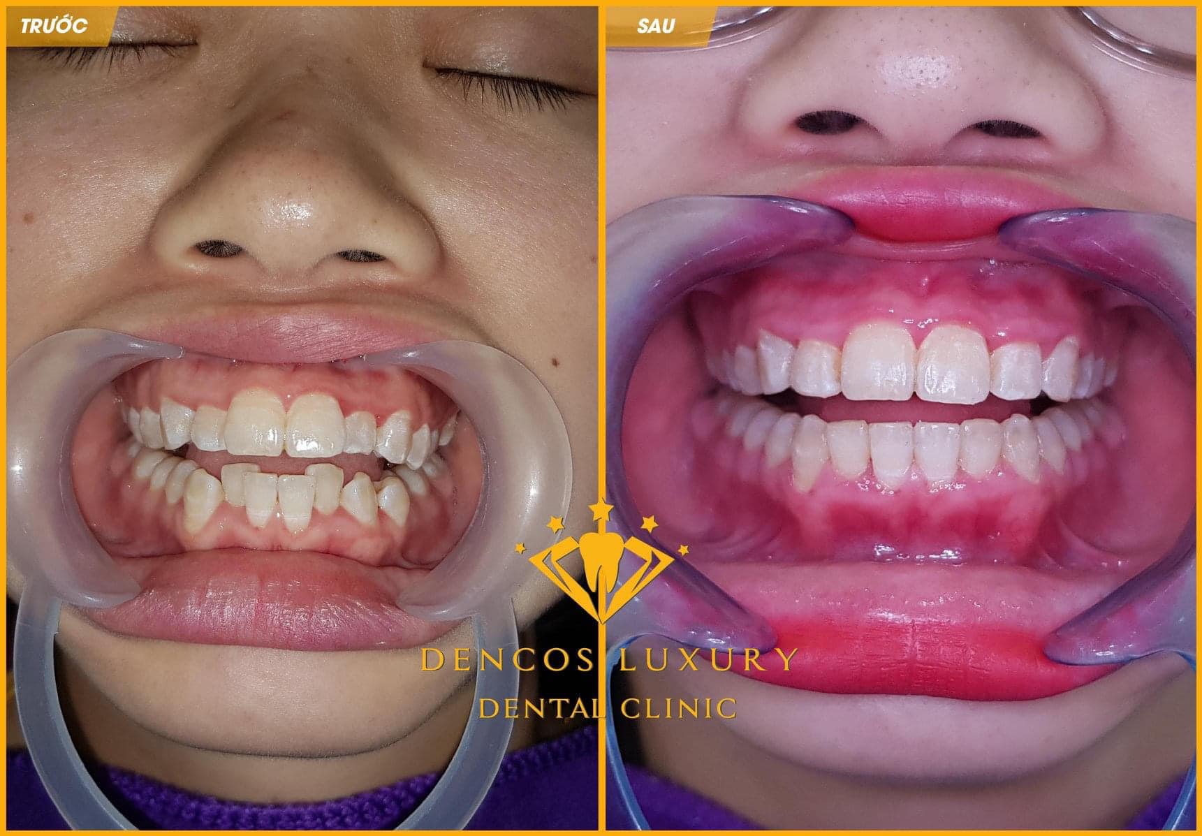 Niềng răng invisalign