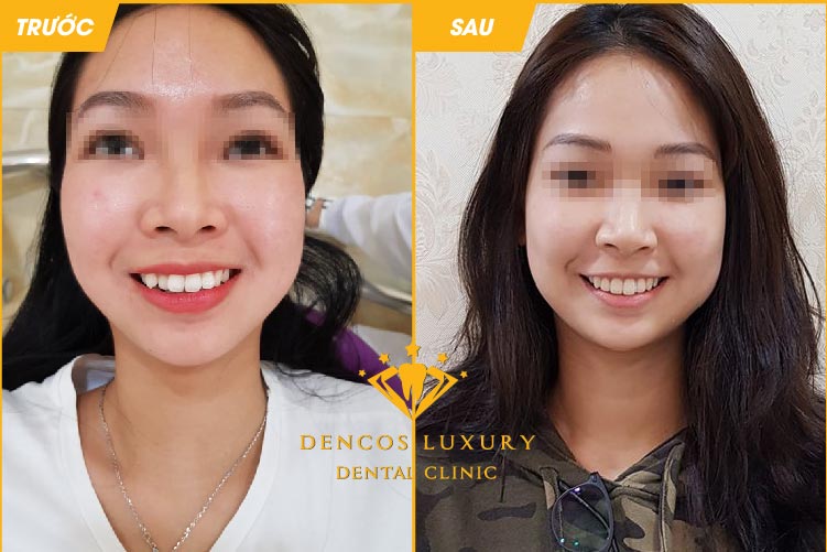 Niềng răng invisalign