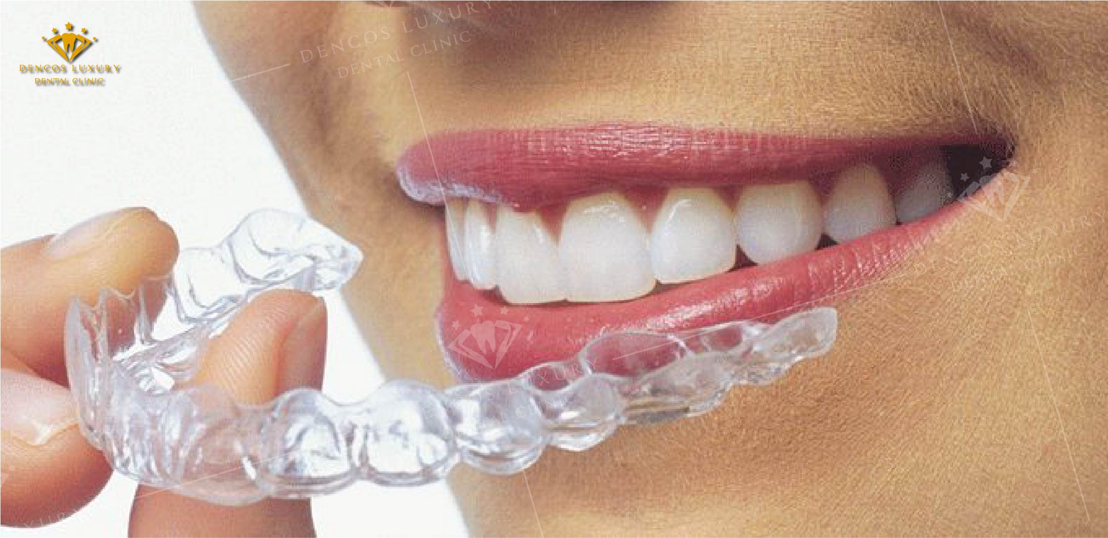 niềng răng invisalign