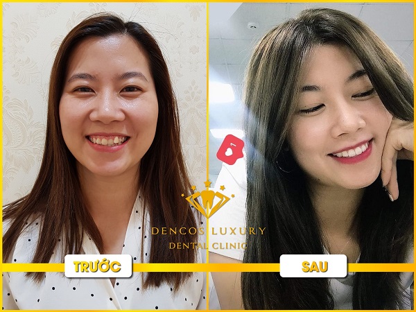 Niềng răng invisalign