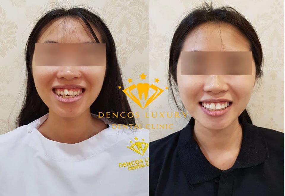 Niềng răng invisalign